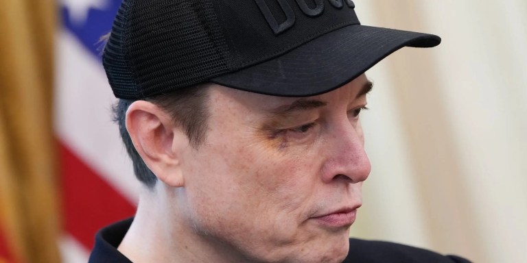 Elon Musk Tells the Story Behind His Black Eye Elon Musk Tells the Story Behind His Black Eye
