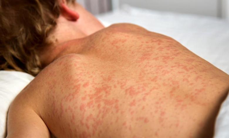 Nova Scotia encourages measles vaccination as the number of cases increases in Canada Nova Scotia encourages measles vaccination as the number of cases increases in Canada