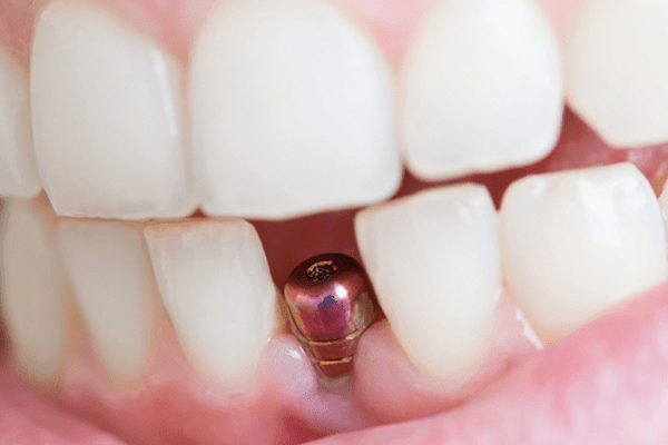 The Journey to Recovery: Understanding Post Dental Implant Care in Melbourne The Journey to Recovery: Understanding Post Dental Implant Care in Melbourne