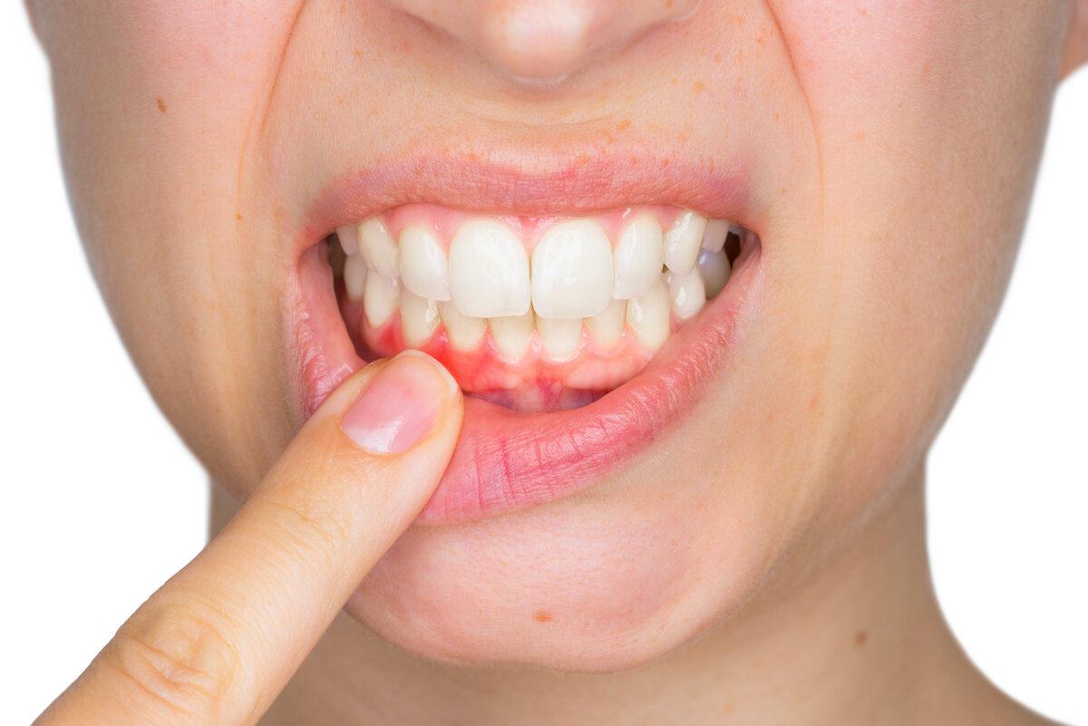 Common Soft Teeth Diseases Common Soft Teeth Diseases