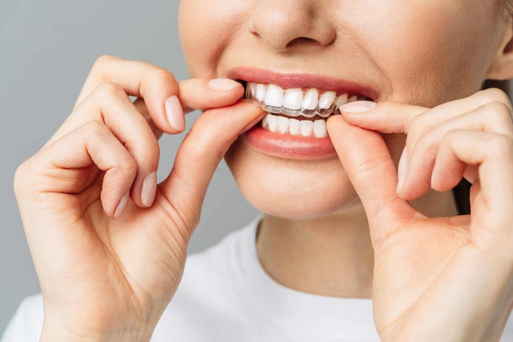 Is Invisalign the Best Option to Straighten Teeth Discreetly? Is Invisalign the Best Option to Straighten Teeth Discreetly?
