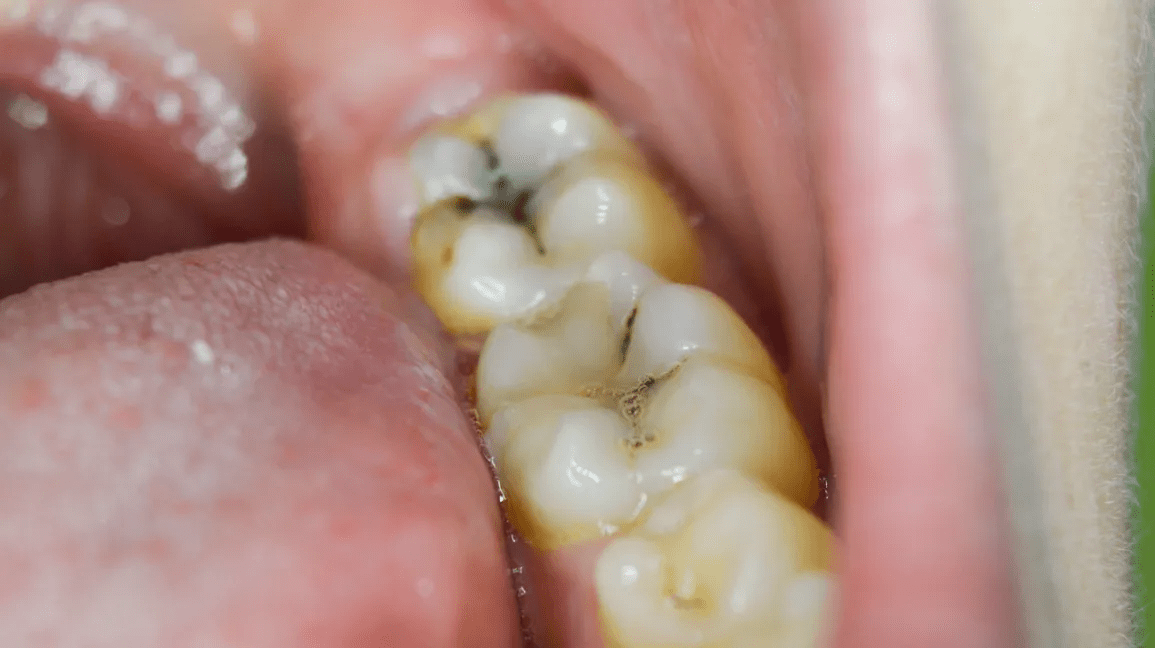 Tooth Decay Causes You Should Avoid Tooth Decay Causes You Should Avoid