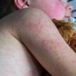 As measles cases rise, some parents become vaccine enthusiasts As measles cases rise, some parents become vaccine enthusiasts