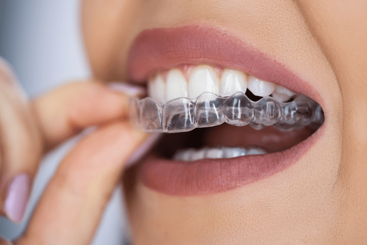 The Benefits of Choosing Invisalign: A Patient’s Perspective The Benefits of Choosing Invisalign: A Patient’s Perspective