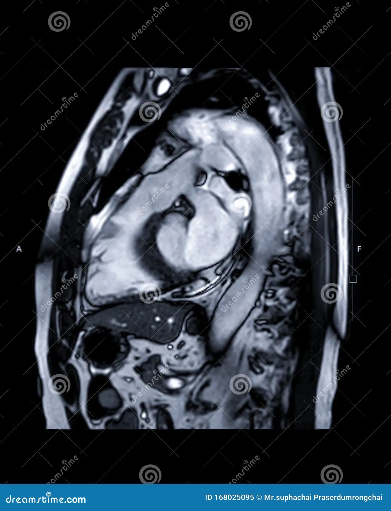 The Role Of Cardiac MRI In Diagnosis The Role Of Cardiac MRI In Diagnosis