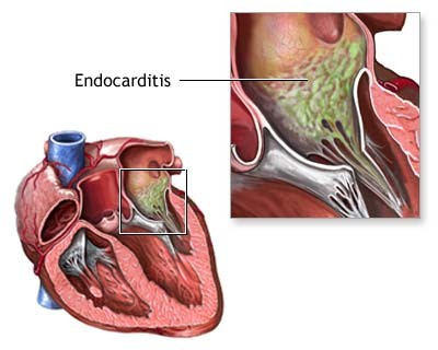 Endocarditis: Infection Of The Heart’s Inner LiningEndocarditis: Infection Of The Heart’s Inner Lining Endocarditis: Infection Of The Heart’s Inner LiningEndocarditis: Infection Of The Heart’s Inner Lining