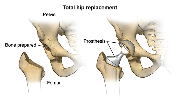 Joint Replacement Surgery: Procedure And Recovery Joint Replacement Surgery: Procedure And Recovery