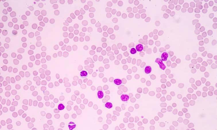 The Economic Burden Of Leukemia Treatment The Economic Burden Of Leukemia Treatment
