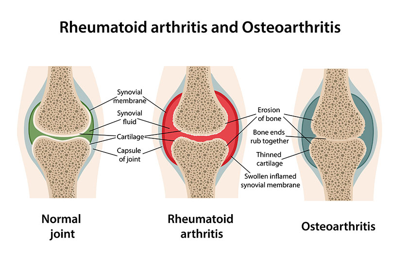 Rheumatoid Arthritis Vs. Osteoarthritis: Key Differences Rheumatoid Arthritis Vs. Osteoarthritis: Key Differences
