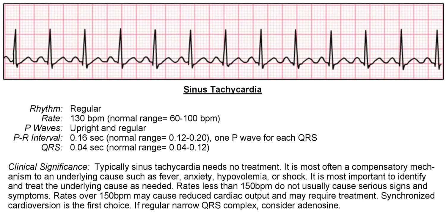 Supraventricular Tachycardia: What It Means Supraventricular Tachycardia: What It Means