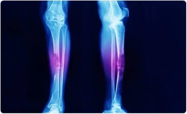 Bone Cancer: Types, Symptoms, And Treatment Options Bone Cancer: Types, Symptoms, And Treatment Options