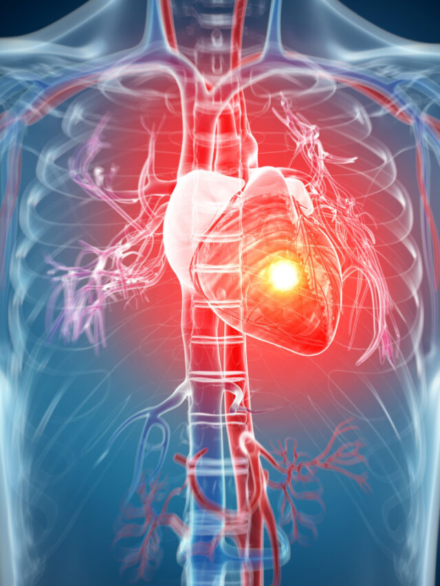 Common Myths About Heart Attacks Common Myths About Heart Attacks