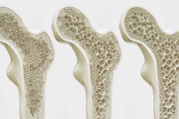 Absolutely! Here’s A Comprehensive Article About Osteoporosis, Covering Its Causes, Symptoms, Prevention, And More. Absolutely! Here’s A Comprehensive Article About Osteoporosis, Covering Its Causes, Symptoms, Prevention, And More.