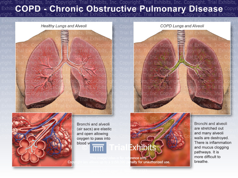 Comorbidities Associated With Common Chronic Diseases – Part 8: Chronic Obstructive Pulmonary Disease (COPD) Comorbidities Associated With Common Chronic Diseases – Part 8: Chronic Obstructive Pulmonary Disease (COPD)