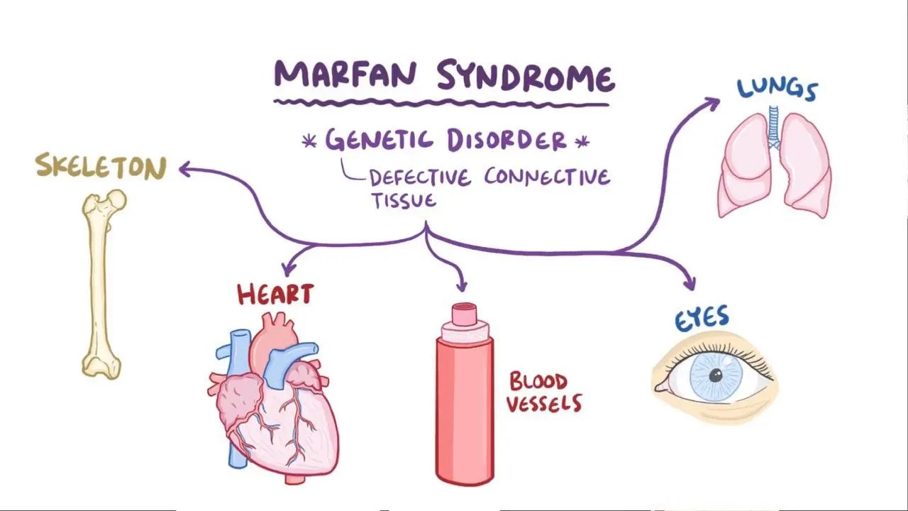 Marfan Syndrome And Cardiovascular Risk Marfan Syndrome And Cardiovascular Risk