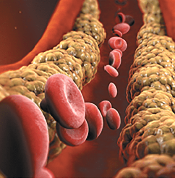 Understanding The Link Between Inflammation And Atherosclerosis Understanding The Link Between Inflammation And Atherosclerosis