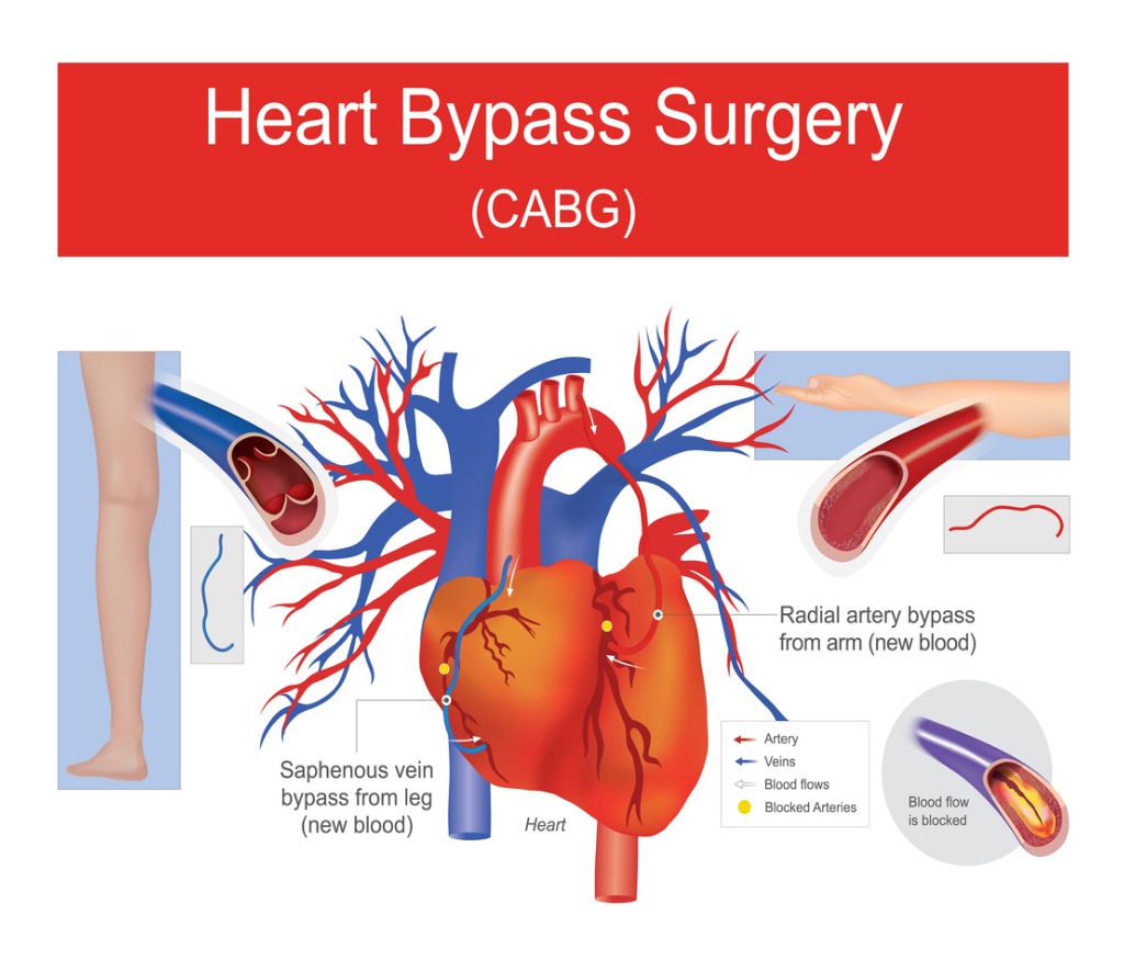 What Is Coronary Artery Bypass Grafting (CABG)? A Comprehensive Overview What Is Coronary Artery Bypass Grafting (CABG)? A Comprehensive Overview