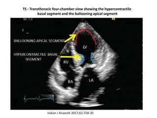 Broken Heart Syndrome: Stress-Induced Cardiomyopathy Broken Heart Syndrome: Stress-Induced Cardiomyopathy