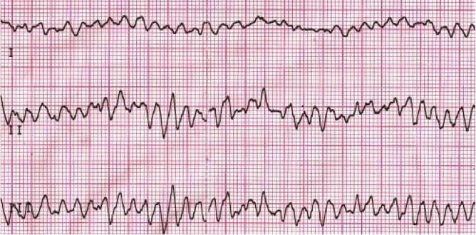 Ventricular Fibrillation: Life-Threatening Arrhythmia Ventricular Fibrillation: Life-Threatening Arrhythmia