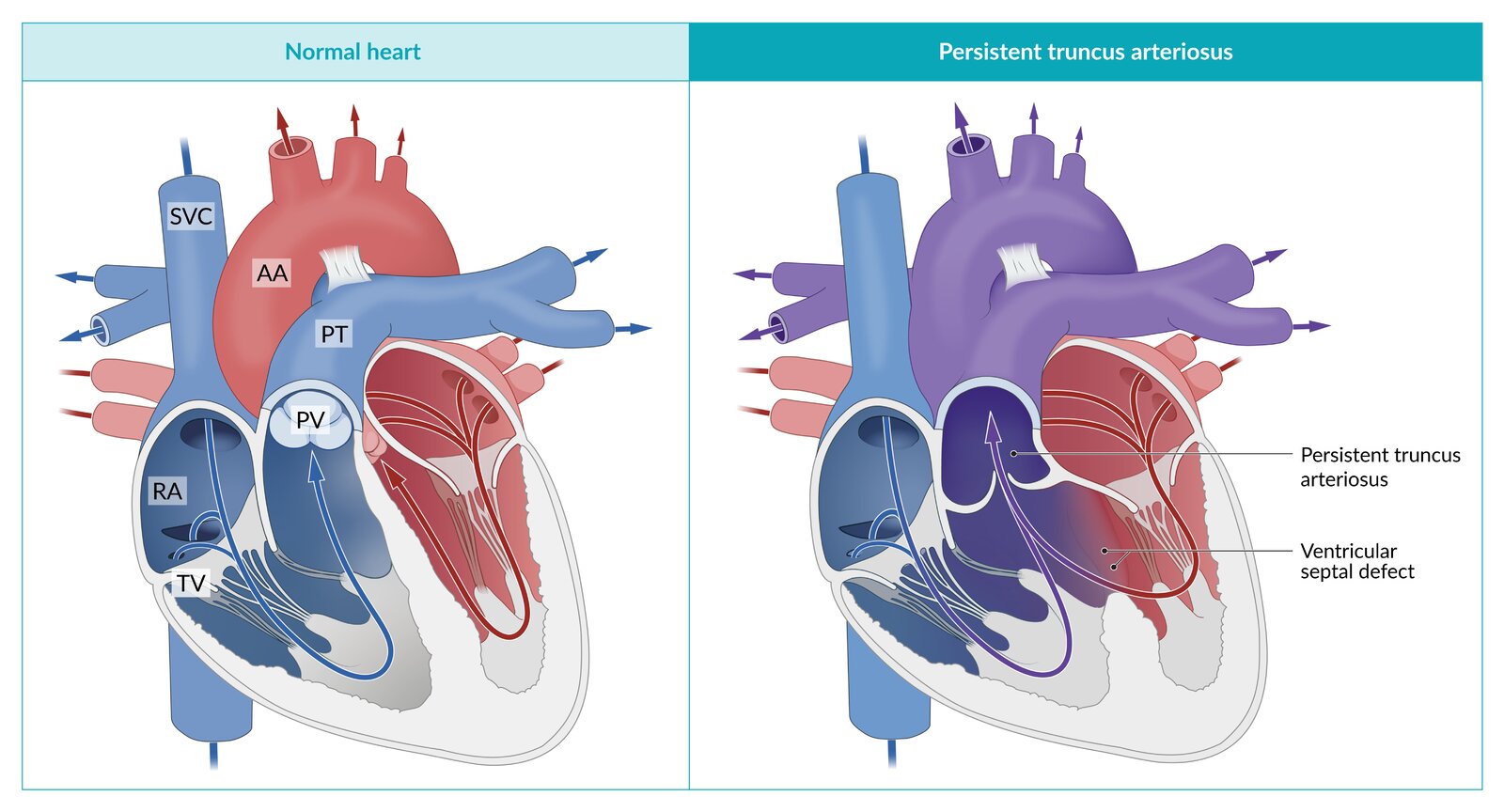 Tetralogy Of Fallot: A Congenital Heart Defect Tetralogy Of Fallot: A Congenital Heart Defect
