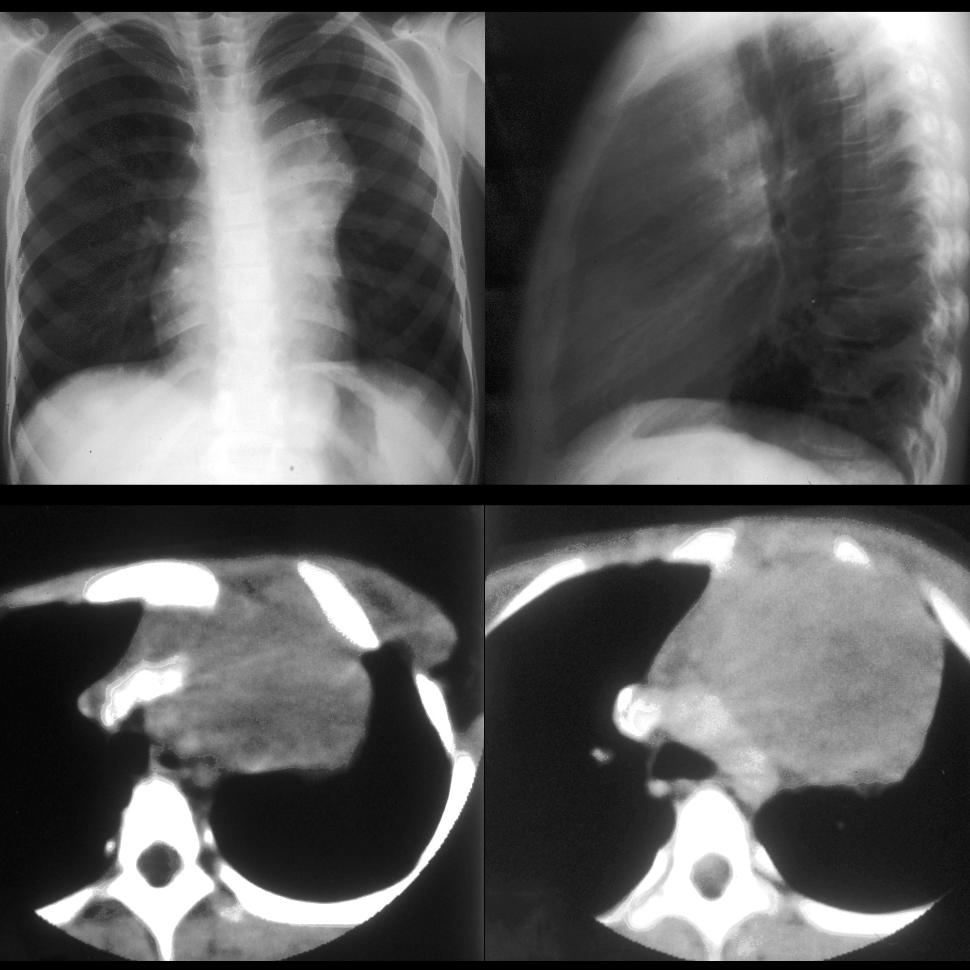 Advances In Diagnostic Imaging For Leukemia Advances In Diagnostic Imaging For Leukemia