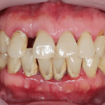 Experienced Soft Teeth Disease Experienced Soft Teeth Disease