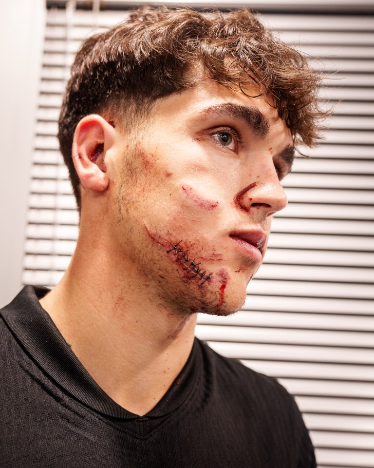 Barcelona star Pau Cubarsi shows off horror facial injuries after 10 stitches Barcelona star Pau Cubarsi shows off horror facial injuries after 10 stitches