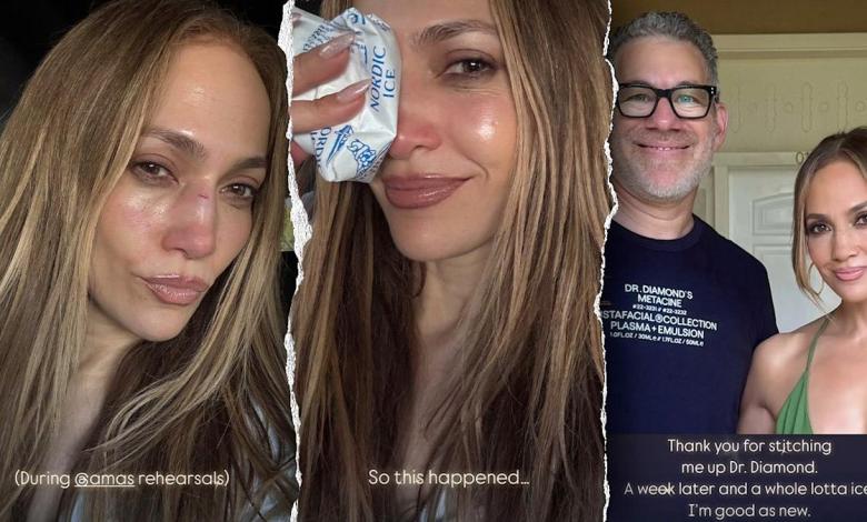 Jennifer López suffers a facial lesion that requires suture points Jennifer López suffers a facial lesion that requires suture points