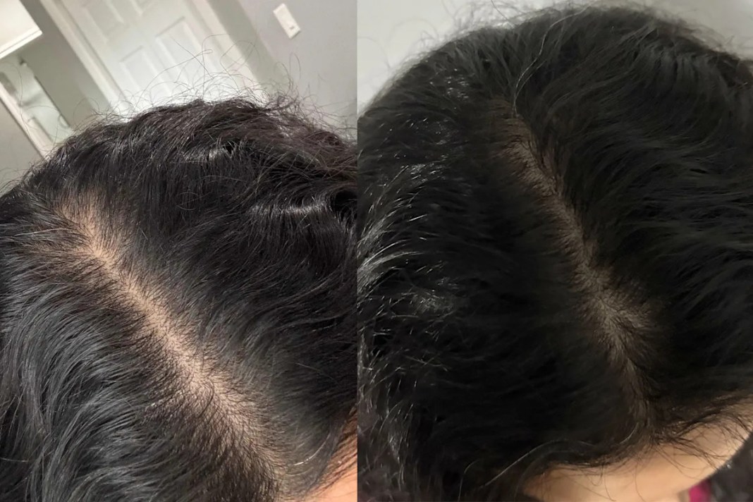 Facing Thinning Hair: Expert Tips on Preventing Hair Loss in Women and 13 Recommended Products