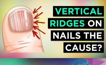 Understanding Nail Health: Vertical Ridges and What They Reveal About Your Body Understanding Nail Health: Vertical Ridges and What They Reveal About Your Body