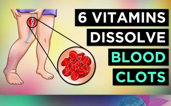 6 Essential Nutrients to Help Prevent and Manage Blood Clots 6 Essential Nutrients to Help Prevent and Manage Blood Clots