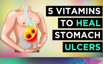 5 Essential Vitamins to Naturally Heal Stomach Ulcers 5 Essential Vitamins to Naturally Heal Stomach Ulcers