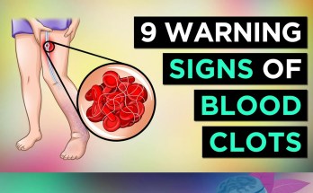 9 Critical Warning Signs of Blood Clots You Should Never Ignore 9 Critical Warning Signs of Blood Clots You Should Never Ignore