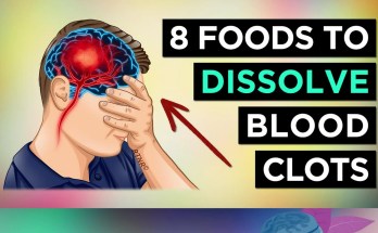 Top 8 Natural Foods to Help Prevent Blood Clots Top 8 Natural Foods to Help Prevent Blood Clots