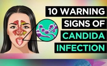 10 Warning Signs of Candida Overgrowth You Shouldn’t Ignore 10 Warning Signs of Candida Overgrowth You Shouldn’t Ignore