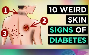 10 Unusual Skin Symptoms That Could Signal Diabetes 10 Unusual Skin Symptoms That Could Signal Diabetes