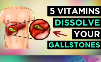 Can Natural Remedies Support Gallstone Management? 5 Vitamins and Nutrients to Consider Can Natural Remedies Support Gallstone Management? 5 Vitamins and Nutrients to Consider