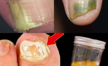 A Simple and Effective Natural Remedy for Nail Fungus A Simple and Effective Natural Remedy for Nail Fungus