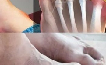 The No. 1 Mineral for Preventing Gout: Magnesium The No. 1 Mineral for Preventing Gout: Magnesium