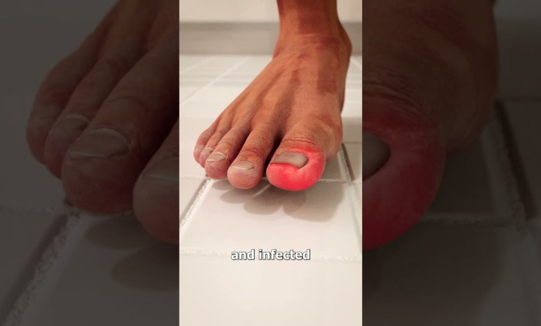 What Is An Ingrown Toenail? 😨 What Is An Ingrown Toenail? 😨