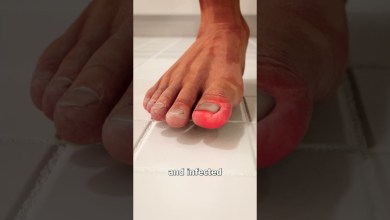 What Is An Ingrown Toenail? 😨 What Is An Ingrown Toenail? 😨