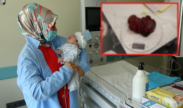Tıp tarihine geçecek ameliyat: Bebeğin boynundan 445 gram tümör çıkarıldı Tıp tarihine geçecek ameliyat: Bebeğin boynundan 445 gram tümör çıkarıldı