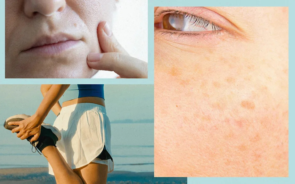 From runner’s face to swimmer’s sunburn: How exercise affects your skin From runner’s face to swimmer’s sunburn: How exercise affects your skin