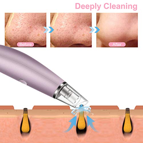 Blackhead Remover Vacuum Pore Cleaner, Alin&Alan Electric Blackhead Vacuum Suction Devices, USB Rechargeable Acne…