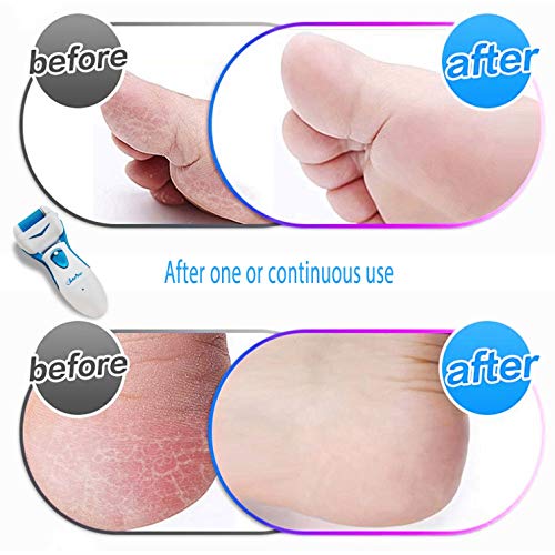Care me Electric Foot Callus Removers Rechargeable – Electronic Foot Grinder Files Away Dry, Dead, Hard, Skin & Calluses…