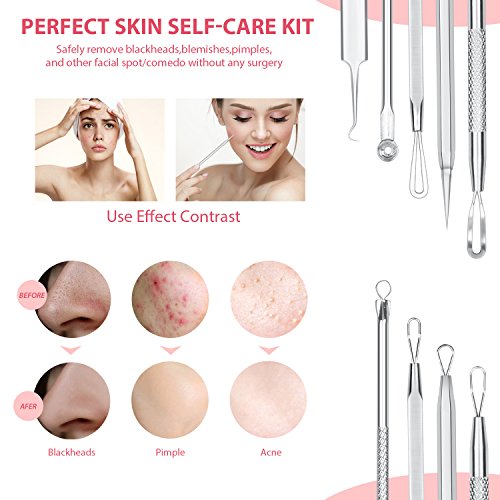 JPNK Blackhead Remover Tool Comedones Extractor Acne Removal Kit for Blemish, Whitehead Popping, 6 Pcs Zit Removing for…