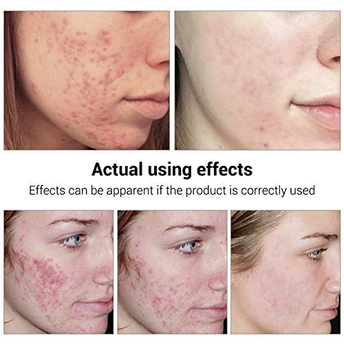 Acne Treatment Serum plus Acne Facial Cleanser, BREYLEE Acne Treatment Set Pimple Clear Skin Kit for Clearing Severe…