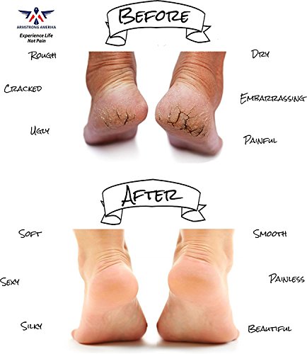 Moisturizing Skin Softening Spa Socks and Gloves with Essential Oil Infused Gel for Dry Cracked Feet and Hands Repair by…