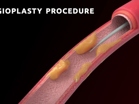 Penile Angioplasty: The Best Treatment for Erectile Dysfunction Penile Angioplasty: The Best Treatment for Erectile Dysfunction