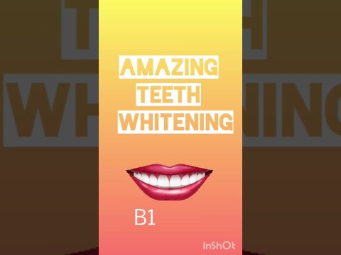 Teeth whitening LIVE DEMO; Dr. Srishti Bhatia Teeth whitening LIVE DEMO; Dr. Srishti Bhatia